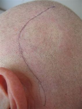 Ritat med penna för tydlighetens skull där ärret ligger. 20 stygn blev det och mottagaren ligger under det lite ljusare partiet bredvid "kröken" till höger. Ritat med penna för tydlighetens skull där ärret ligger. 20 stygn blev det och mottagaren ligger under det lite ljusare partiet bredvid "kröken" till höger.