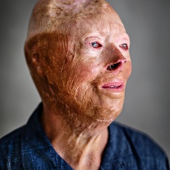 Lasse suffered a very serious workplace accident as a fireman when he was young. Today he lectures about his journey and how he managed to turn a negative experience into something positive.