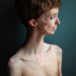 Dylan Lombard is one of only fifteen people in the world with MDP syndrome, a rare genetic condition. Despite living with autism and walking difficulties, he shines as a remarkable dancer, sharing his