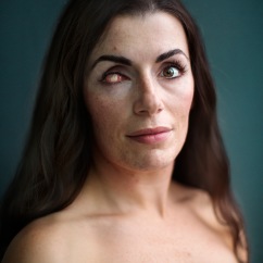 Hattie suffers from severe psoriasis and has, for the past few years, worn an ocular prosthesis in one eye. She runs an Instagram account where she shares her journey and presents herself both with an