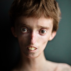 Dylan Lombard is one of only fifteen people in the world with MDP syndrome, a rare genetic condition. Despite living with autism and walking difficulties, he shines as a remarkable dancer, sharing his