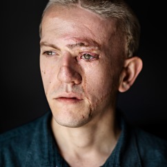  Rob was born with a facial birthmark that left him with visible scarring after surgery. He is now an actor and an outspoken advocate against discrimination based on appearance, campaigning for perfor