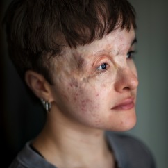 Beau was born with a large birthmark on her face. She works as an actor and is an ambassador for Changing Faces.
