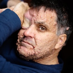 Oliver has a condition called Neurofibromatosis type 1 (NF1), which causes tumours to grow along his nerves.