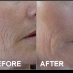ULTRASOUND IONTOFORES BEFORE- AFTER