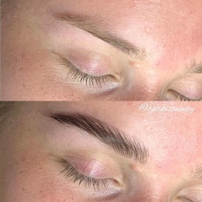 Browlift Browlift