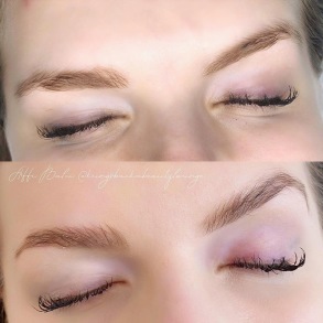 Browlift Browlift
