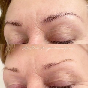 Browlift Browlift