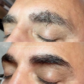 Browlift Browlift