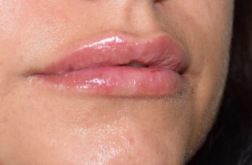 Bild tagen direkt efter behandling med Restylane Lyps 1,0 ml Bild tagen direkt efter behandling med Restylane Lyps 1,0 ml