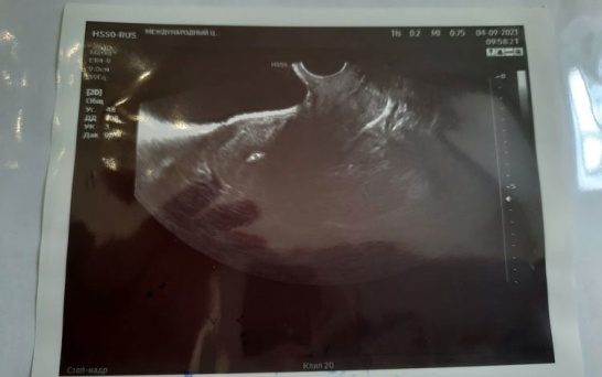 Första insättningen i Ryssland är gjord. Mellan de två små prickarna ligger embryot. Nu hoppas vi att det fungerar. Håll tummarna! Första insättningen i Ryssland är gjord. Mellan de två små prickarna ligger embryot. Nu hoppas vi att det fungerar. Håll tummarna!