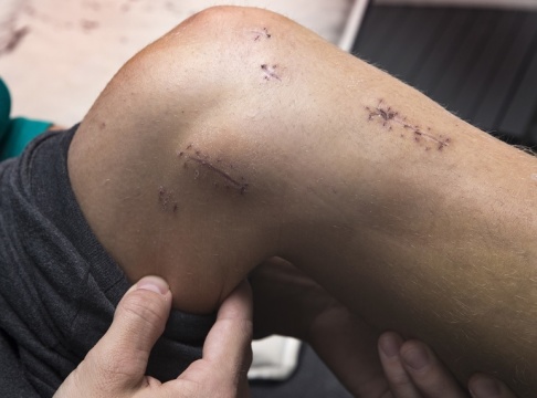 Terje Bendiksby/NTB/TT Unga idrottare som drabbats av främre korsbandsskada bör ägna sig åt rehabilitering i minst ett års tid för att minska risken att samma skada uppstår igen. Arkivbild. Terje Bendiksby/NTB/TT Unga idrottare som drabbats av främre korsbandsskada bör ägna sig åt rehabilitering i minst ett års tid för att minska risken att samma skada uppstår igen. Arkivbild.