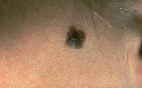 American Academy of Dermatology via AP/TT Många patienter med långt framskriden hudcancer kan överleva med rätt behandling, visar ny forskning. Arkivbild. American Academy of Dermatology via AP/TT Många patienter med långt framskriden hudcancer kan överleva med rätt behandling, visar ny forskning. Arkivbild.