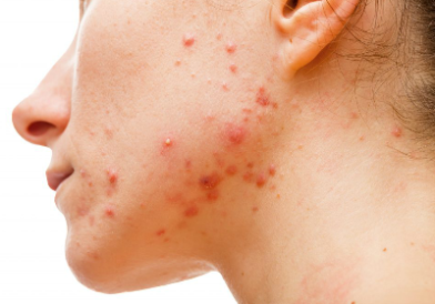 Vid acne, rosacea & ökad pigmentering Vid acne, rosacea & ökad pigmentering