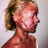 Burn make-up from "Syrror" TV4
