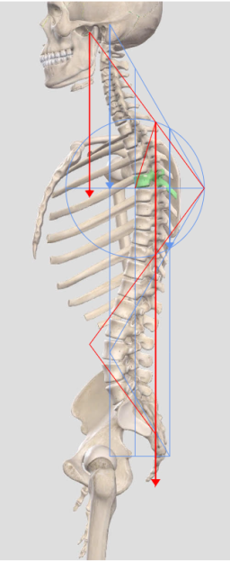 Anteriorly imbalanced sagittal alignment.