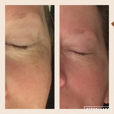Före/efter Pure Cell Treatment, 60 min Före/efter Pure Cell Treatment, 60 min
