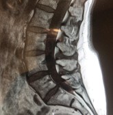 Röntgenbild på ländrygg