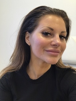 Direkt efter Hollywoodpeeling. Direkt efter Hollywoodpeeling.