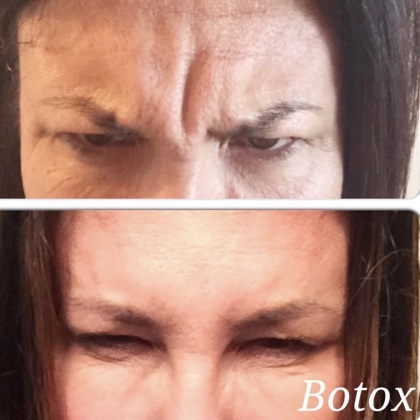 Före och efter 2 veckor - Glabella (arga rynkan) Före och efter 2 veckor - Glabella (arga rynkan)