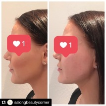 fillers haka, fillers kinder, fillers haka, fillers kinder,