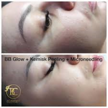bb glow och microneedling behandling och utbildning bb glow och microneedling behandling och utbildning