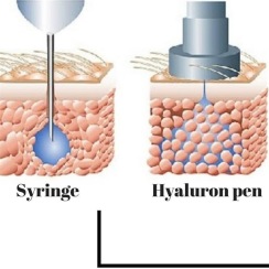 HYALURON METODEN HYALURON METODEN
