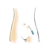 Peritoneal kateter utsidan